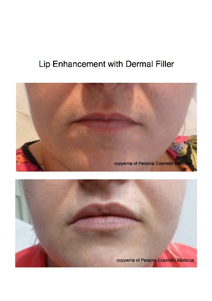 Lips with dermal Fillers